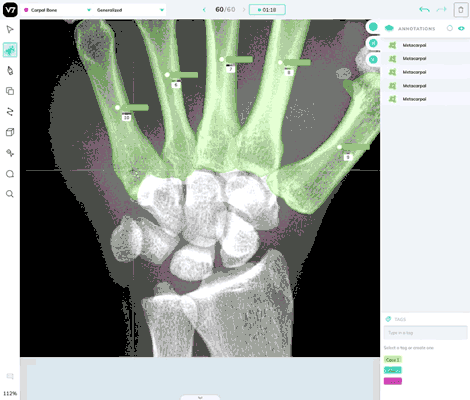 AI-Image-Labeling---Carpometacarpal-joint-dislocations-in-X-Ray.gif